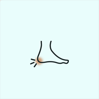 Plantar Fasciitis